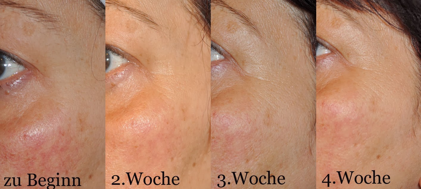 Die Creme für die Abtragung der Pigmentflecke mit der Plazenta